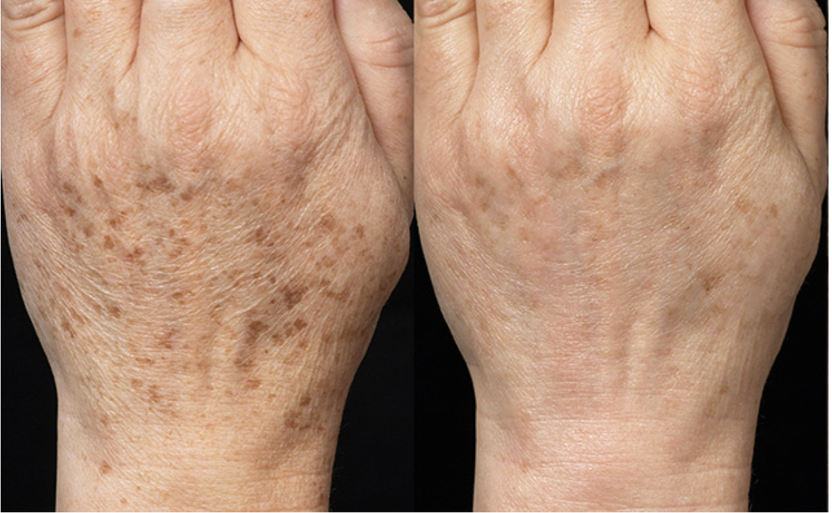 Laser Hautabtragung3 Vorher Nachher Dermatologie Hanau